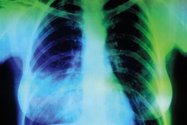 Magyarországon már ritka betegségnek számít a tbc