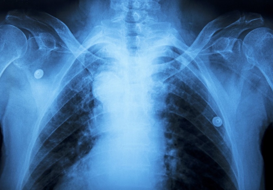 Pfizers-Lung-Cancer-Drug-Surpises-1024x682.jpg lcc