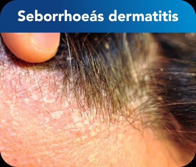 Seborrheas dermatitis