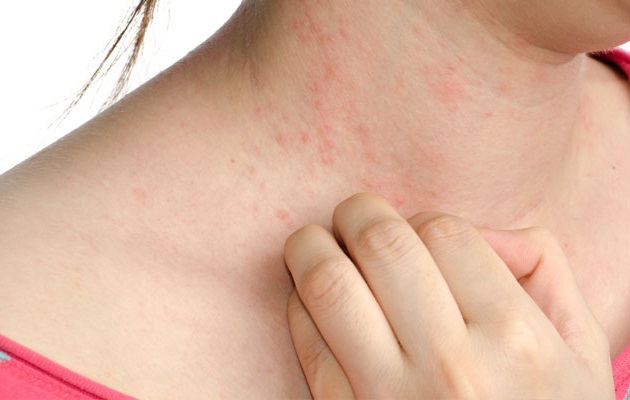 eczema