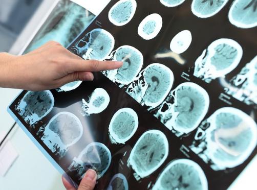alzheimers_web_credit_shutterstock_0.jpg agy