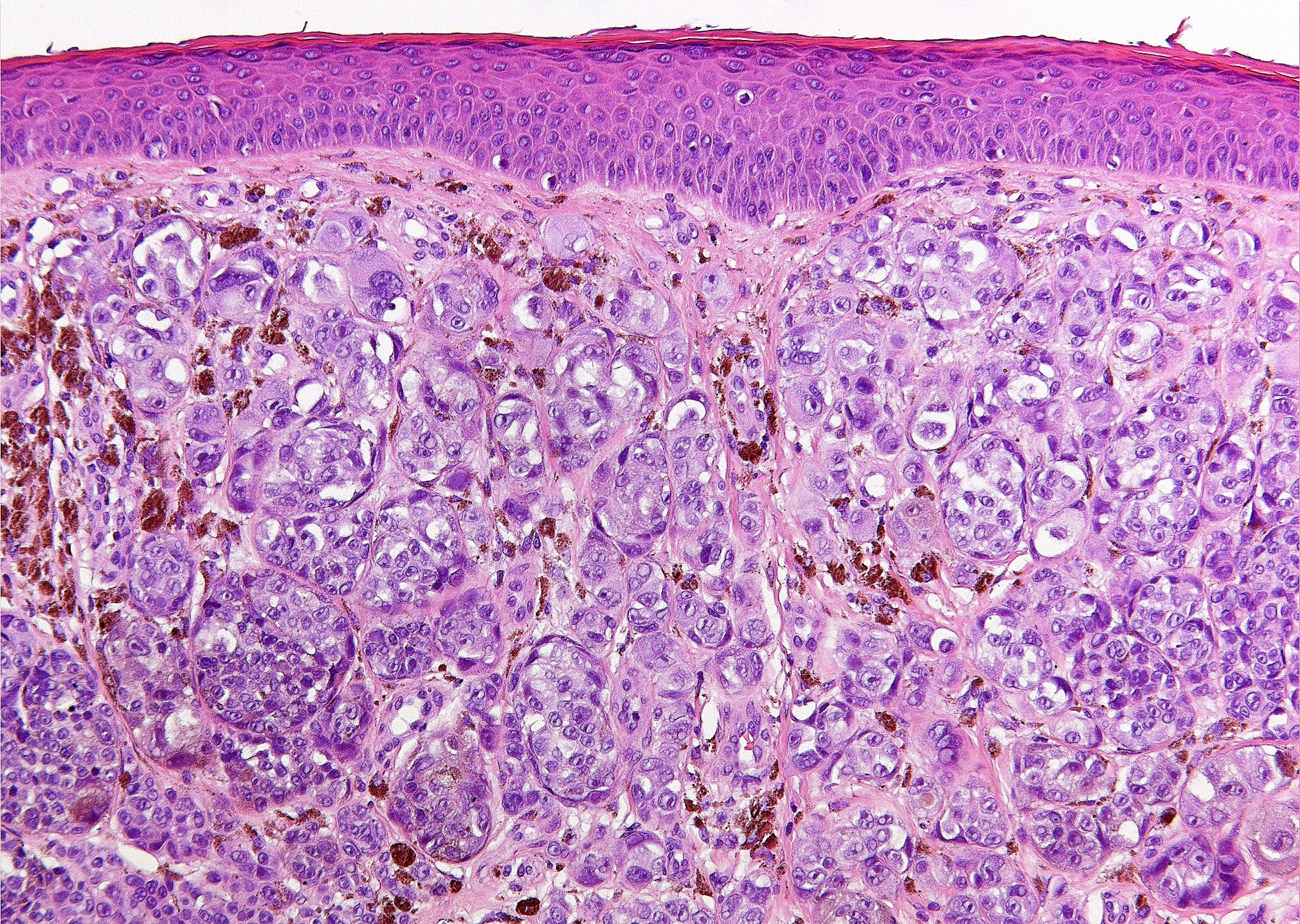 melanoma