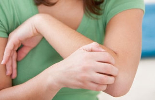 psoriasis