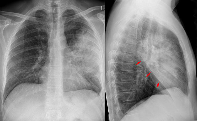 Pneumonie-1.jpeg Pneumonie