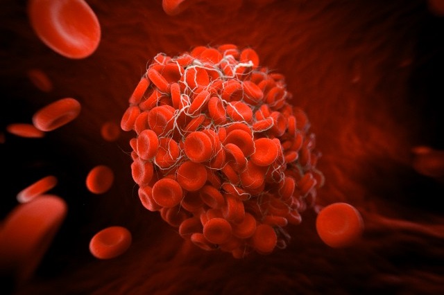 Venous-Thromboembolism.jpg vte