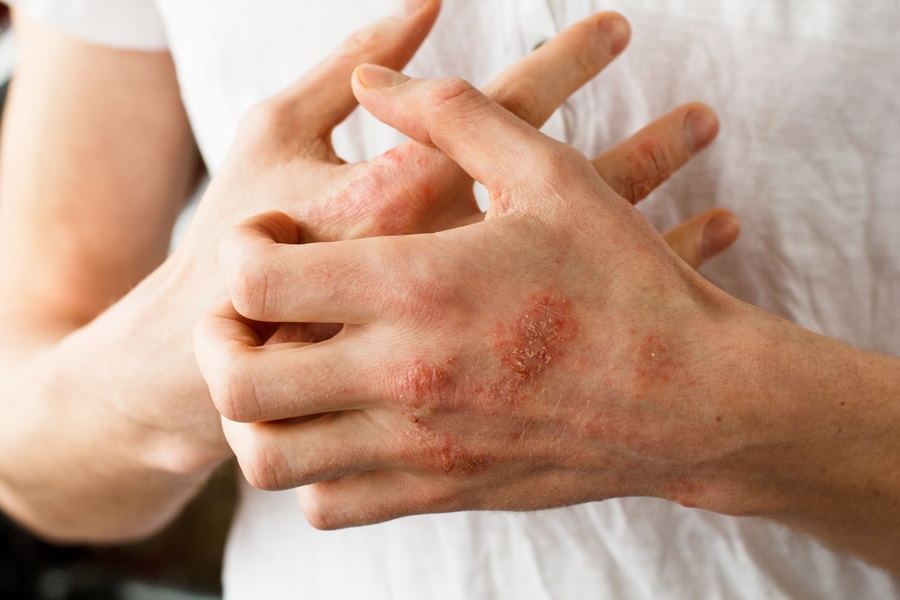 psoriasis