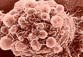Kutatási dilemmák: a rák genetikai vagy metabolikus betegség? | PHARMINDEX Online